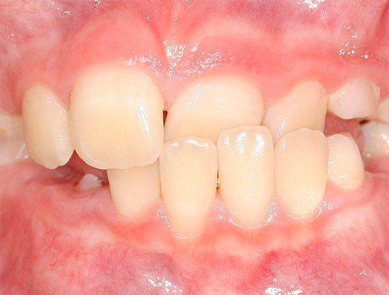 There are many different types of tooth bite anomalies - we will talk about them later ...