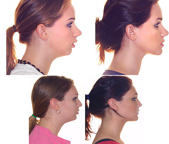 Dopo il trattamento (correzione) del morso distale, la forma della mascella inferiore subisce cambiamenti significativi.