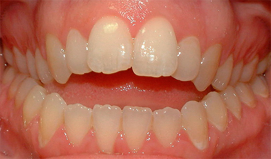 כאשר השיניים בחלק הקדמי אינן נסגרות, הן מדברות על נשיכה גלויה.