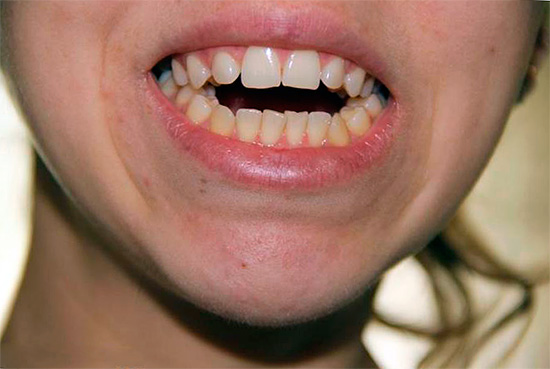 Often with an open bite, closing your mouth completely is problematic.