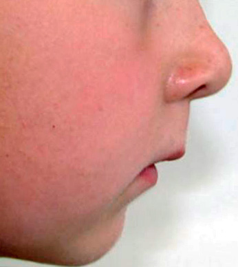 مع لدغة عميقة ، واحدة من العلامات المميزة هي تقصير كبير في الثلث السفلي من الوجه.