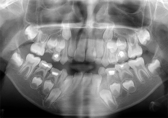 Ortopantomograma em criança (imagem panorâmica da dentição).