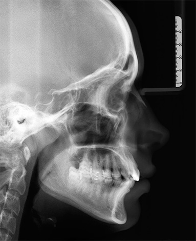 Hình ảnh tele-roentgenogram của đầu giúp bác sĩ chỉnh nha đưa ra kết luận về nguyên nhân của sự phát triển của một hoặc một malocclusion khác.