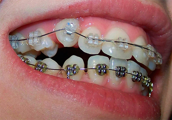 มันควรจะเป็นพาหะในใจว่าการแก้ไขการกัดด้วยความช่วยเหลือของการจัดฟันใช้เวลามากถึงหลายปี