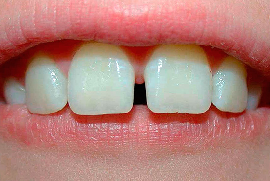 The photo shows an example of a median diastema.
