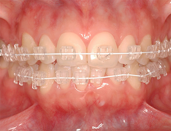 Sapphire braces are among the most invisible on the teeth.