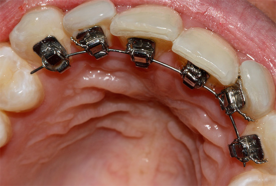 Lingualni grudnjaci pričvršćeni su na unutarnju (jezičnu) stranu zuba, tako da su drugima nevidljivi.
