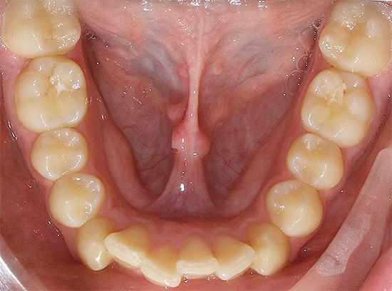Salah satu anomali gigitan yang paling umum adalah kerapuhan gigi.