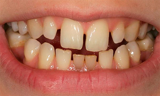 La causa della comparsa di tre (lacune) può essere la microdentia - le piccole dimensioni dei singoli denti di fila.