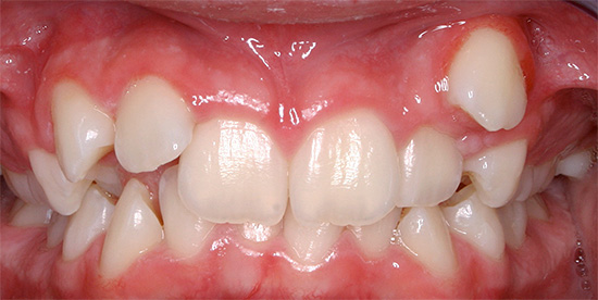 Kadang-kadang gigi boleh meletup di tempat yang tidak biasa untuk itu, yang akhirnya membawa kepada pembentukan malocclusion.