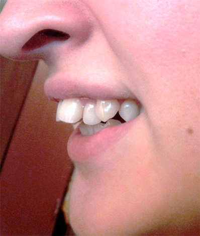 Um exemplo de mordida distal quando os incisivos superiores são inclinados em direção ao lábio.