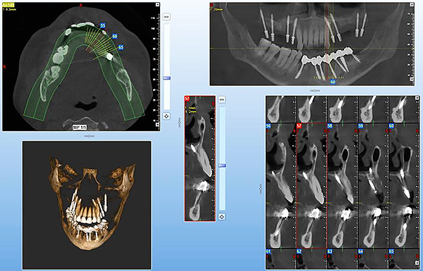 Computer modeling with basal implantation allows you to achieve the most accurate positioning of implants even in the most difficult cases, minimizing the likelihood of a medical error.