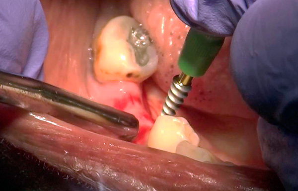 Bazální implantáty mohou být často instalovány bez výrazných gingiválních řezů - metoda tzv. Vpichu (kruhový řez).