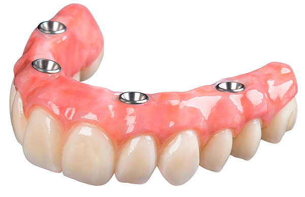 Η πρόθεση που χρησιμοποιείται στην τεχνολογία προσθετικής οδοντοστοιχίας All-on-4.