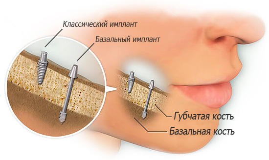Os implantes basais são colocados no osso basal denso da mandíbula.