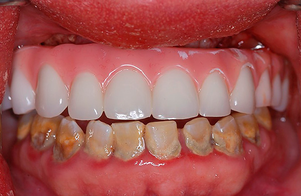 As próteses em implantes basais são possíveis mesmo se o paciente apresentar formas graves de periodontite e doença periodontal.