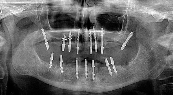 The correct installation of basal implants requires a very high level of training from the doctor, which creates certain difficulties - it is not so easy to find such a specialist ...