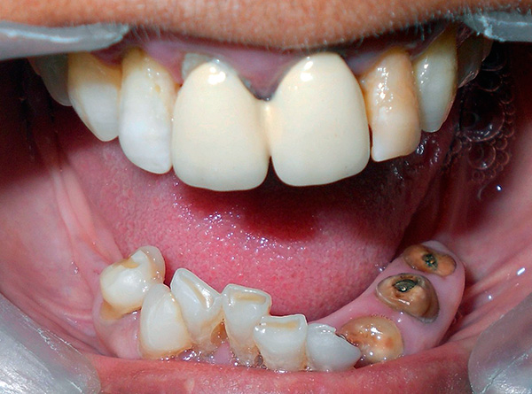 Az alapimplantáció indikációja a 3-nál nagyobb mennyiségű fogak hiánya.
