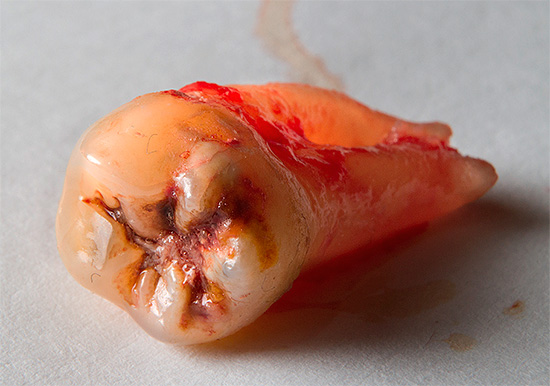 Zubní chirurg často po extrakci také nainstaluje implantát.
