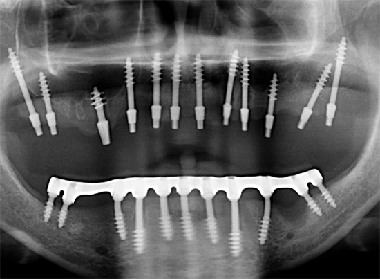 Deze röntgenfoto laat duidelijk zien dat basale implantaten vrij lang kunnen zijn ...