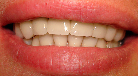 Przy odpowiedniej pielęgnacji jamy ustnej cermet może trwać ponad 10 lat i być może przez całe życie.