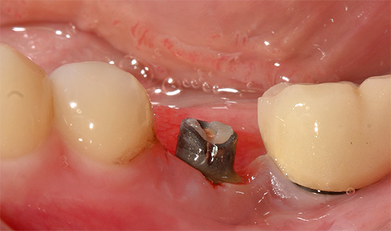 Inflammation i området för ett installerat implantat kallas peri-implantit.