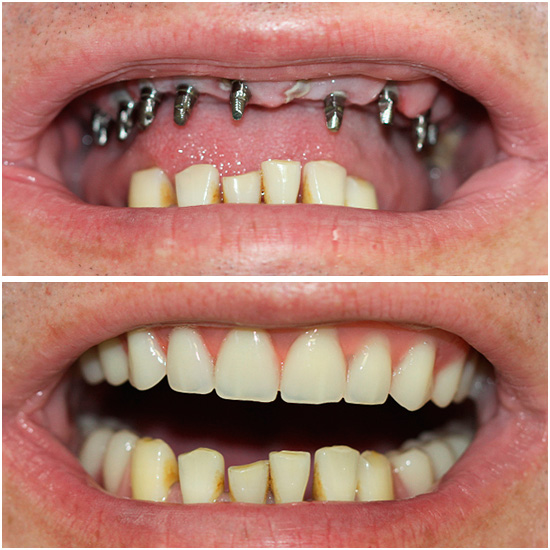 La implantación basal realmente tiene muchas ventajas, por ejemplo, le permite devolver rápidamente una hermosa sonrisa a una persona.