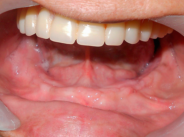 مثال على ترميم الأسنان في الفك السفلي باستخدام الغرسات القاعدية.