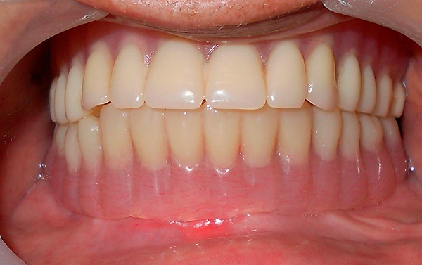 Ant implantų yra sumontuotas protezas - taip atstatoma dantų estetika ir funkcionalumas.