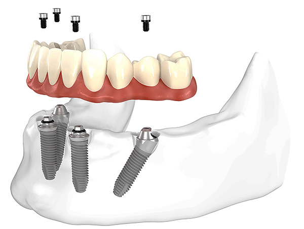 A imagem mostra esquematicamente as próteses dos dentes usando o método All-on-4 (em quatro implantes).