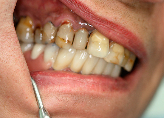Før proceduren undersøges tilstanden i patientens mundhule og kæbe grundigt.