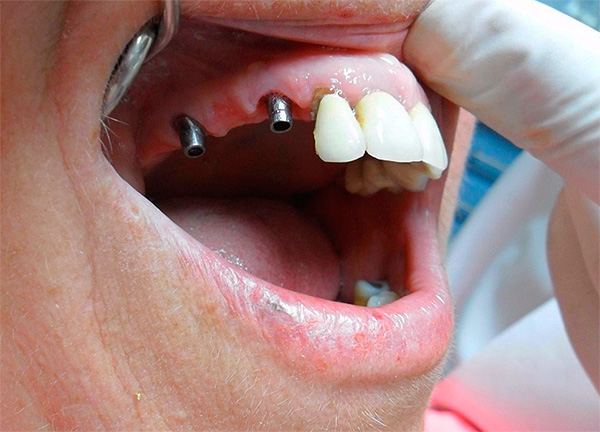 دعنا نحاول معرفة المضاعفات التي تنشأ أحيانًا بعد زراعة الأسنان وكيفية تقليل خطر المشكلات المختلفة ...