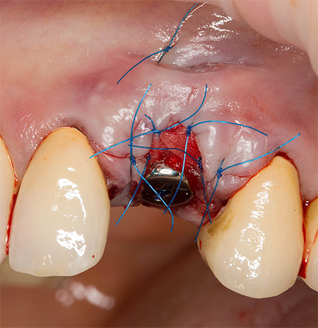 Na implantatie worden hechtingen op het tandvlees geplaatst.