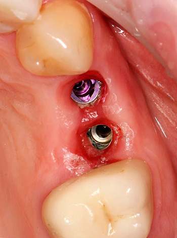 Periimplantitis, yerleşik diş implantları bölgesinde bir iltihaptır.