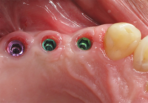 Heutzutage wird die Operation der Zahnimplantation in den meisten Fällen ohne Komplikationen durchgeführt.