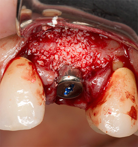 Das Foto zeigt ein Beispiel für die Implantatinsertion zusammen mit der Knochentransplantation.