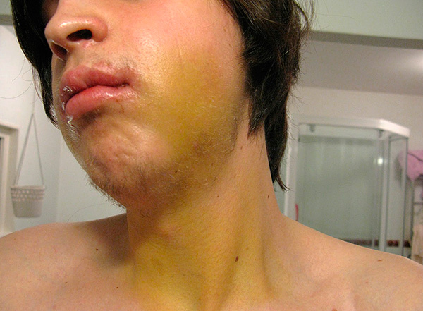 Dažreiz pēc implantu uzstādīšanas uz sejas un pat kakla var novērot hematomu.