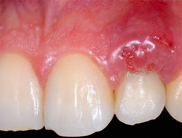 Kuvassa on tulehdukset yläleuan hampaan implantin alueella - valitettavasti implantin jälkeisiä komplikaatioita tapahtuu toisinaan edelleen.