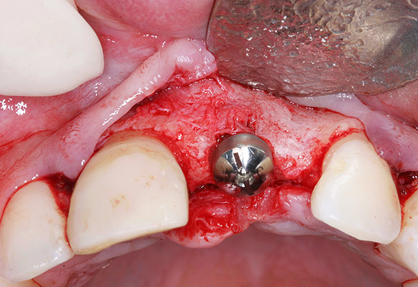 Problēmas var rasties gan operācijas laikā, gan pēc šķietami veiksmīgās implanta uzstādīšanas.