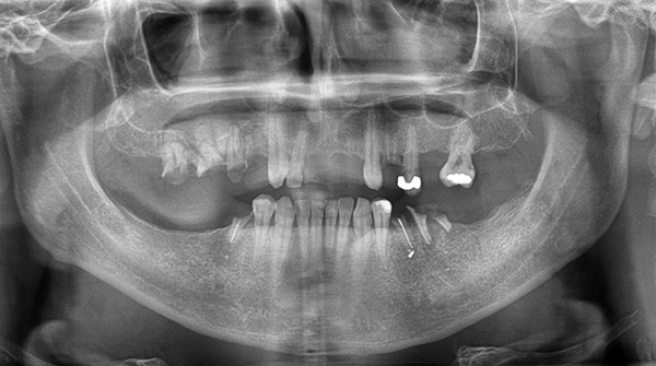 This panoramic image clearly shows that the distance from the teeth of the upper jaw to the maxillary sinuses is very small.