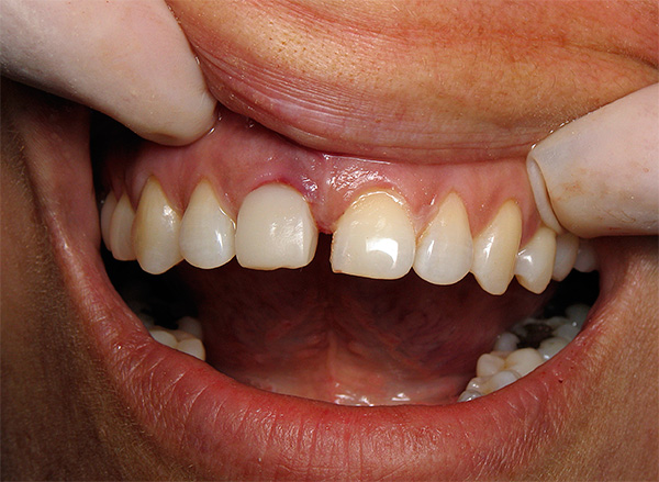 Diş implantı ret sürecine eşlik edebilecek semptomlar ve en önemlisi, bu hoş olmayan fenomen riskini nasıl azaltacağımız hakkında konuşalım ...