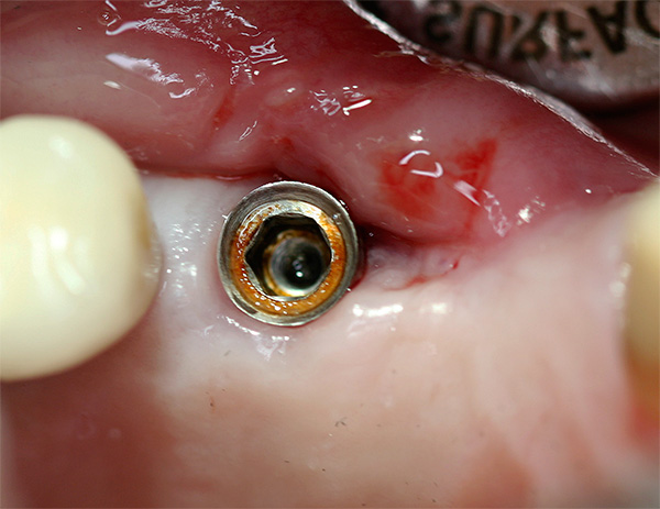 Corrosione dell'impianto dentale