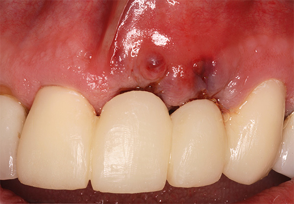 Ženkliai pablogėjus bendrajai sveikatai, dantų implantų problemos gali prasidėti net po daugelio metų po jų sumontavimo.