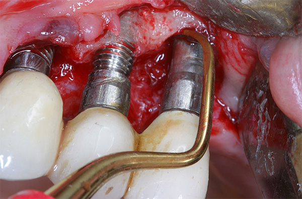 Vid svår inflammation kan läkaren öppna tandköttet och rengöra såret från pus.