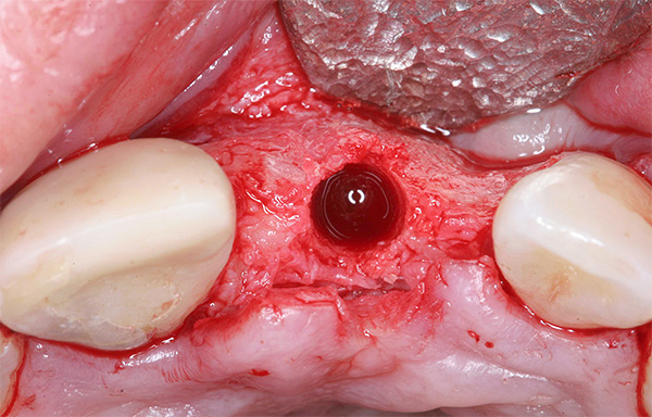La foto muestra un ejemplo de implantación repetida después de la restauración del tejido óseo del proceso alveolar.