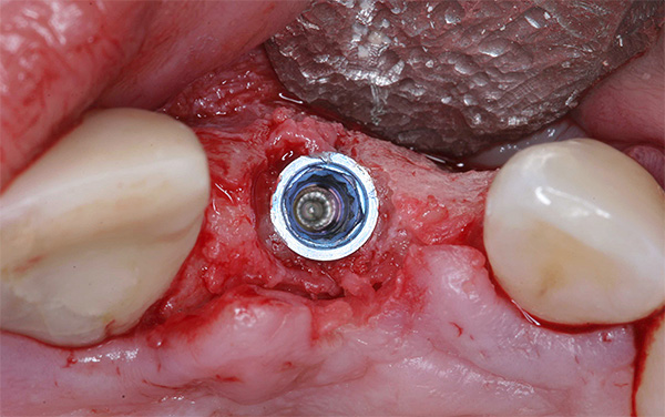 Et implantat blir implantert i det gjenopprettede beinet.