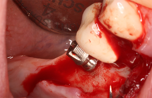 Die Zahnimplantation ist ein eher traumatischer chirurgischer Eingriff.
