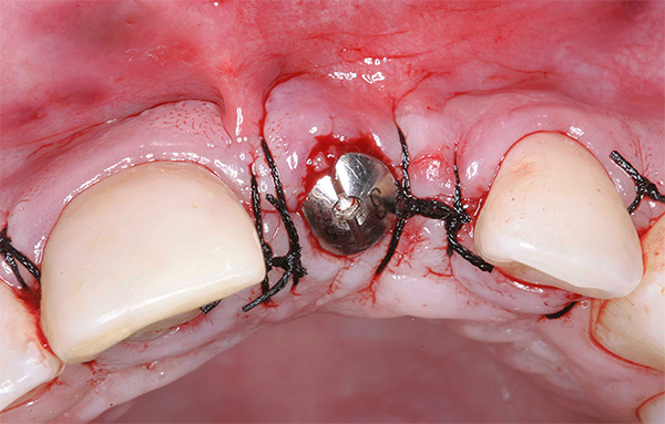 En plugg er plassert på implantatet, og såret sutureres.