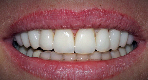 Siellä on joitain yksinkertaisia ​​vinkkejä, joilla vältetään monet hammasimplanttien hylkäämiseen liittyvät ongelmat ...