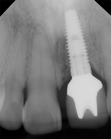 Le processus de fusion de l'implant avec l'os de la mâchoire est affecté par de nombreux facteurs, et certains d'entre eux peuvent parfois compliquer l'ostéointégration.